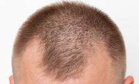 Hair Transplants for Women: Restoring Confidence and Beauty