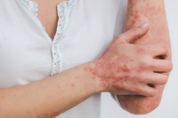 Związek między AZS a alergiami - co należy wiedzieć